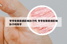 爺爺有銀屑病影響孫子嗎 爺爺有銀屑病影響孫子嗎知乎