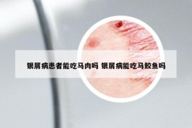 銀屑病患者能吃馬肉嗎 銀屑病能吃馬鮫魚嗎
