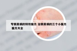 專銀屑病的特效偏方 治銀屑病的三個(gè)小偏方 偏方大全