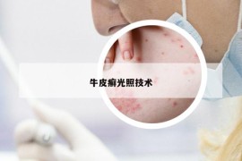 牛皮癬光照技術(shù)