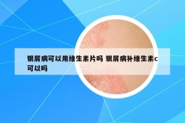 銀屑病可以用維生素片嗎 銀屑病補維生素c可以嗎