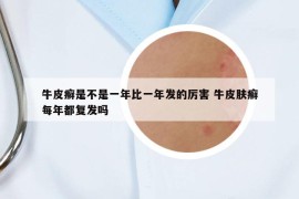 牛皮癬是不是一年比一年發(fā)的厲害 牛皮膚癬每年都復(fù)發(fā)嗎