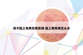 孩子腿上有兩處銀屑病 腿上銀屑病怎么辦