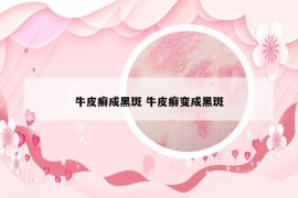 牛皮癬成黑斑 牛皮癬變成黑斑