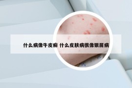 什么病像牛皮癬 什么皮膚病很像銀屑病