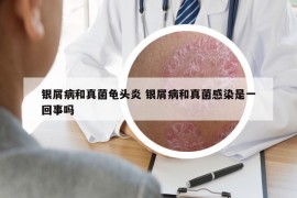 銀屑病和真菌龜頭炎 銀屑病和真菌感染是一回事嗎