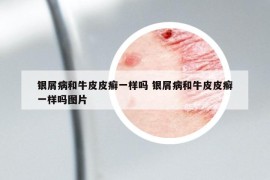銀屑病和牛皮皮癬一樣嗎 銀屑病和牛皮皮癬一樣嗎圖片