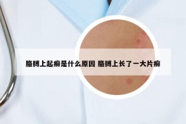 胳膊上起癬是什么原因 胳膊上長(zhǎng)了一大片癬