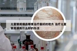 兒童銀屑病去哪里治療最好的地方 治療兒童銀屑病有什么好的辦法