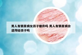 男人有銀屑病女孩子嫌棄嗎 男人有銀屑病會遺傳給孩子嗎
