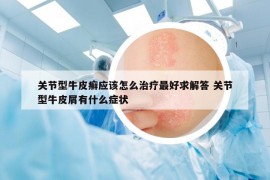 關節(jié)型牛皮癬應該怎么治療最好求解答 關節(jié)型牛皮屑有什么癥狀