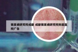 銀屑病研究院成都 成都銀屑病研究院附屬醫(yī)院廣告