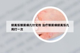 修美樂銀屑病幾針見效 治療銀屑病修美樂幾周打一次