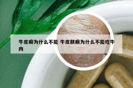 牛皮癬為什么不能 牛皮膚癬為什么不能吃牛肉