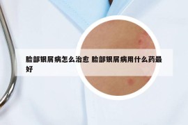 臉部銀屑病怎么治愈 臉部銀屑病用什么藥最好