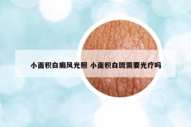小面積白癜風(fēng)光照 小面積白斑需要光療嗎