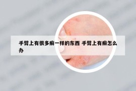 手臂上有很多癬一樣的東西 手臂上有癬怎么辦