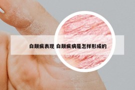 白顛瘋表現(xiàn) 白顛瘋病是怎樣形成的