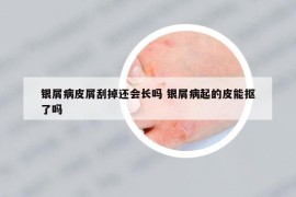 銀屑病皮屑刮掉還會(huì)長(zhǎng)嗎 銀屑病起的皮能摳了嗎