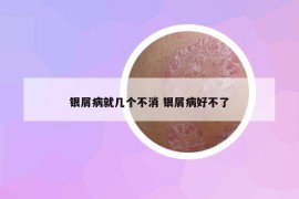 銀屑病就幾個不消 銀屑病好不了