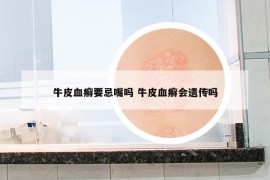 牛皮血癬要忌嘴嗎 牛皮血癬會遺傳嗎