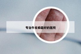 專治牛皮癬最好的醫(yī)院