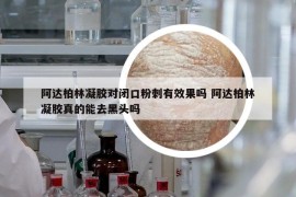 阿達(dá)柏林凝膠對(duì)閉口粉刺有效果嗎 阿達(dá)柏林凝膠真的能去黑頭嗎