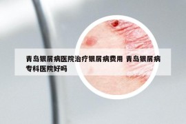青島銀屑病醫(yī)院治療銀屑病費(fèi)用 青島銀屑病專科醫(yī)院好嗎