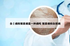 白疕病和銀屑病是一種病嗎 銀屑病和白斑病