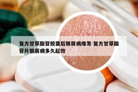 復(fù)方甘草酸苷膠囊后銀屑病爆發(fā) 復(fù)方甘草酸苷片銀屑病多久起效