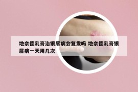 地奈德乳膏治銀屑病會(huì)復(fù)發(fā)嗎 地奈德乳膏銀屑病一天用幾次