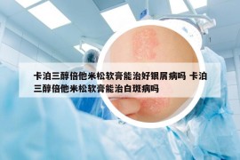 卡泊三醇倍他米松軟膏能治好銀屑病嗎 卡泊三醇倍他米松軟膏能治白斑病嗎