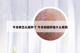 牛皮癬怎么腿腫了 牛皮癬腿腫是什么原因