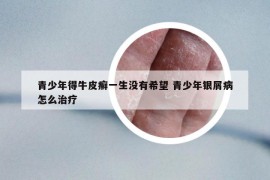 青少年得牛皮癬一生沒(méi)有希望 青少年銀屑病怎么治療