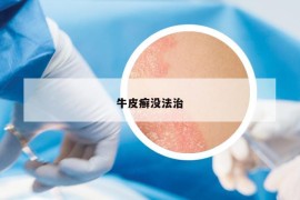 牛皮癬沒(méi)法治