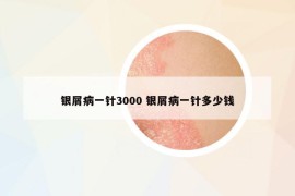 銀屑病一針3000 銀屑病一針多少錢