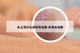 頭上為什么會(huì)長吃毛癬 頭發(fā)吃毛癬