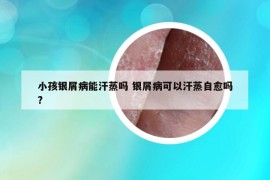 小孩銀屑病能汗蒸嗎 銀屑病可以汗蒸自愈嗎?