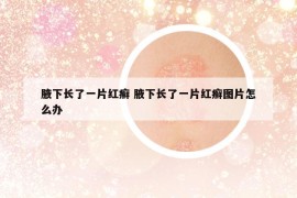 腋下長了一片紅癬 腋下長了一片紅癬圖片怎么辦