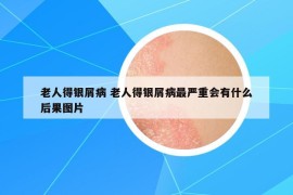 老人得銀屑病 老人得銀屑病最嚴(yán)重會(huì)有什么后果圖片