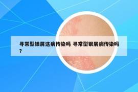 尋常型銀屑這病傳染嗎 尋常型銀屑病傳染嗎?