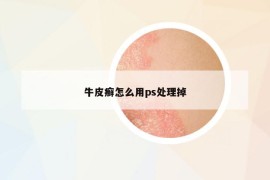 牛皮癬怎么用ps處理掉