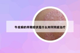 牛皮癬的早期癥狀是什么如何徹底治療