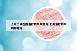 上海三甲醫(yī)院治療銀屑病最好 上海治療銀屑病哪兒好
