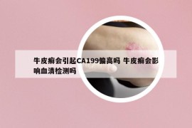 牛皮癬會(huì)引起CA199偏高嗎 牛皮癬會(huì)影響血清檢測嗎