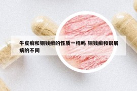 牛皮癬和銅錢癬的性質(zhì)一樣嗎 銅錢癬和銀屑病的不同