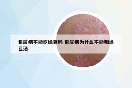 銀屑病不能吃綠豆嗎 銀屑病為什么不能喝綠豆湯