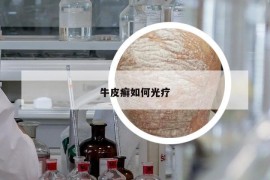 牛皮癬如何光療