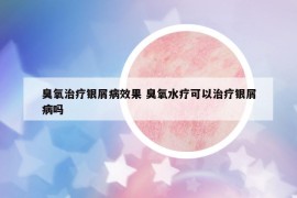 臭氧治療銀屑病效果 臭氧水療可以治療銀屑病嗎
