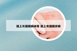 腿上長圓圈癬掉屑 腿上有圓圈狀癬